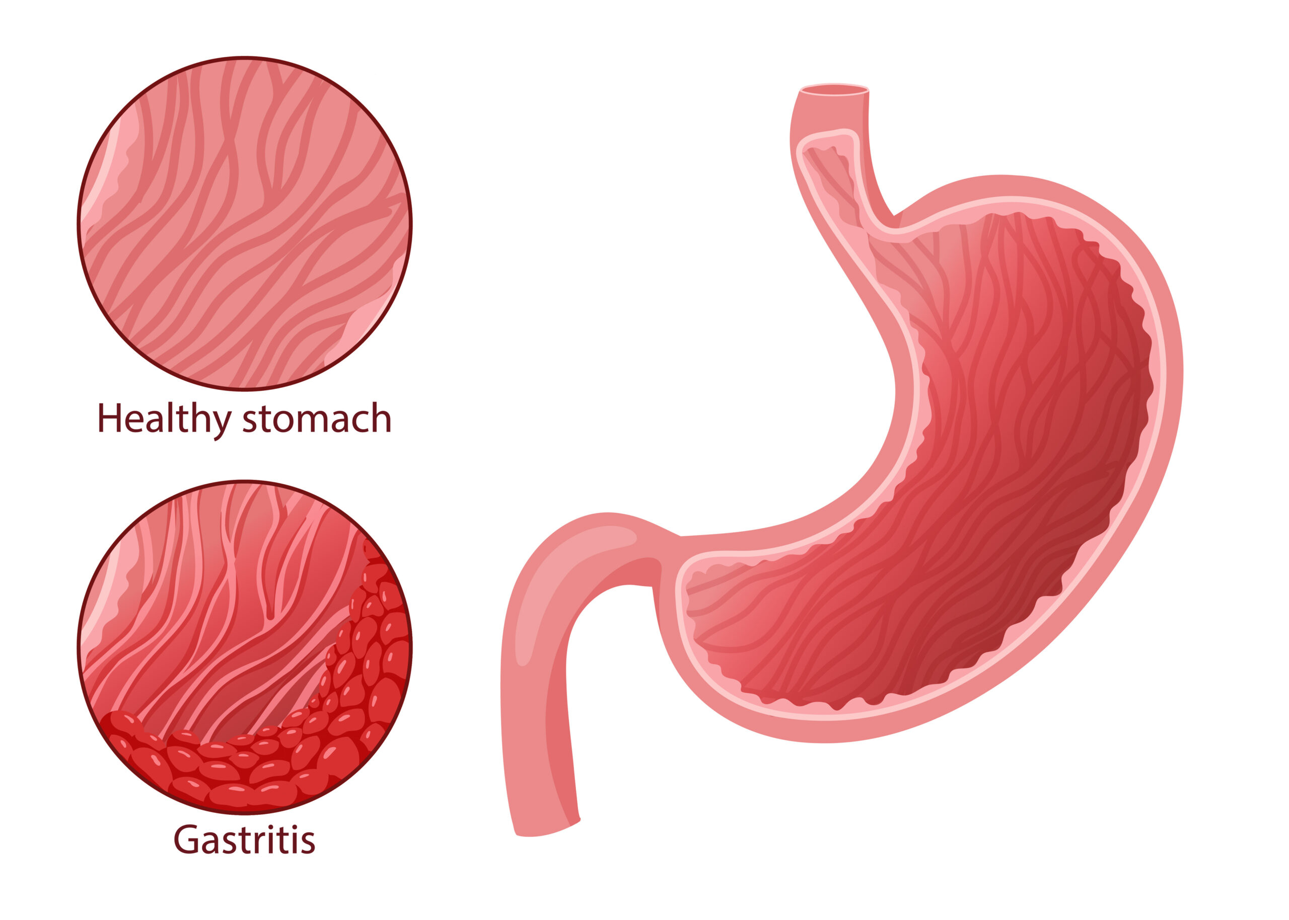 Healthy stomach and gastritis illustration